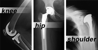 Knee, Hip, and Shoulder implant x-ray images